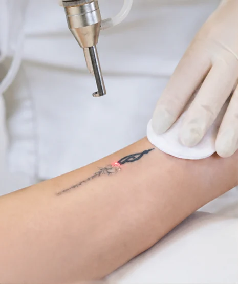 Laser tattoo removal